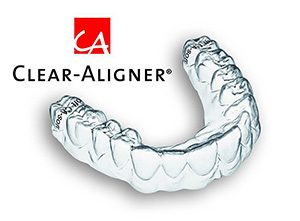 clear-aligner-small