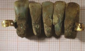 A prótese possui cinco dentes de pessoas diferentes presos por uma barra de ouro (Fonte: Divulgação)