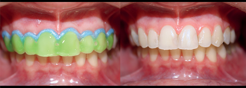 Clareamento dentário