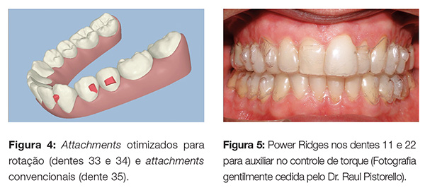 https://dentalpress.com.br/wp-content/uploads/2014/01/clinica_v12_n06_06fig04_5.jpg