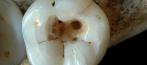 Dente-de-14-mil-anos-mostra-tratamento-de-cárie-720x320