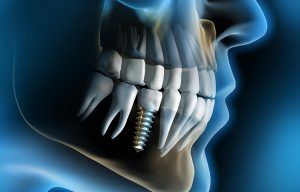 Dental-Implants