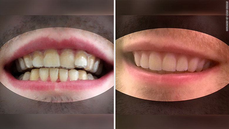 https://dentalpress.com.br/wp-content/uploads/2016/10/160315144855-amos-dudley-before-after-780x439-1.jpg