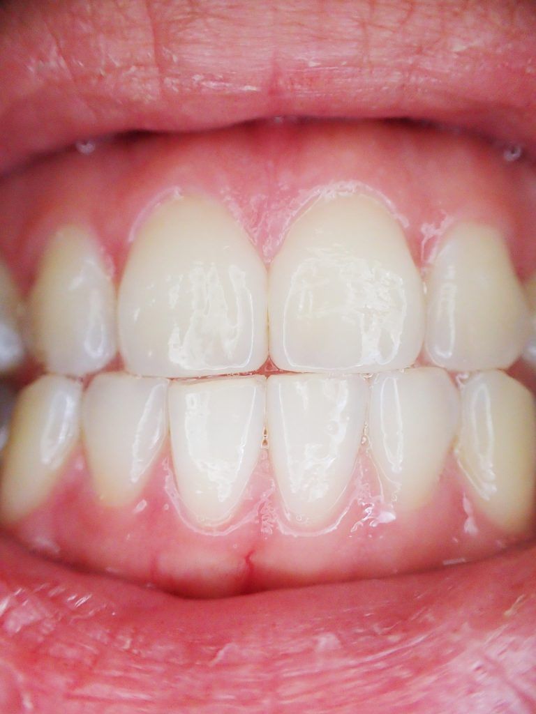 Doença periodontal; Periodontite; Gengivite; Gum disease; Universidade de Birmingham