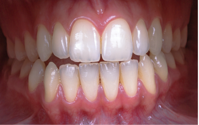 Tomate pode reduzir risco de doenças gengivais graves