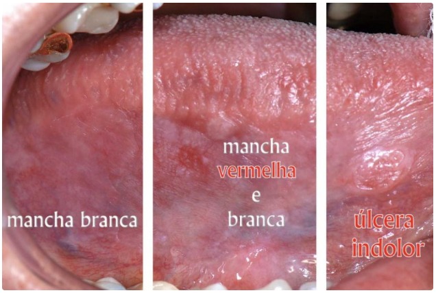 Onde ocorre mais o câncer dentro da boca?