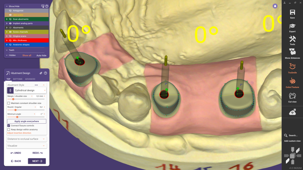 Lançamento do exocad DentalCAD 3.3 Chemnitz