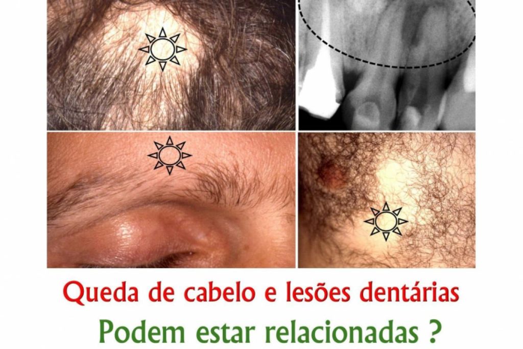 Dente com lesão e queda de cabelo