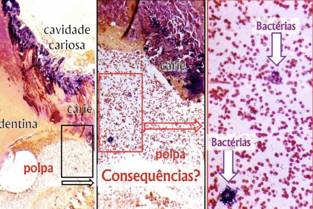 Tem bactérias na polpa dentária
