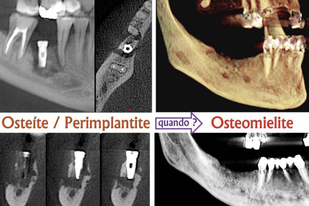 Quando a cirurgia de implante evolui para Osteomielite